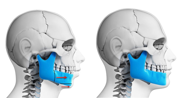 Cirurgia Ortognatica