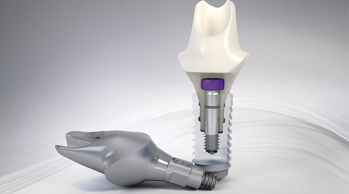 Implantes Dentários