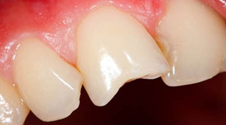 Traumatismo dentario